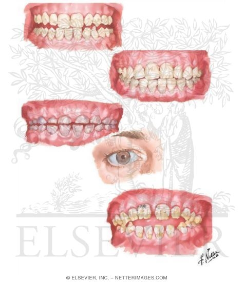 Dental Abnormalities
