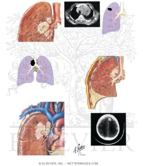 Lung Cancer (Stage IIIA and IIIB)