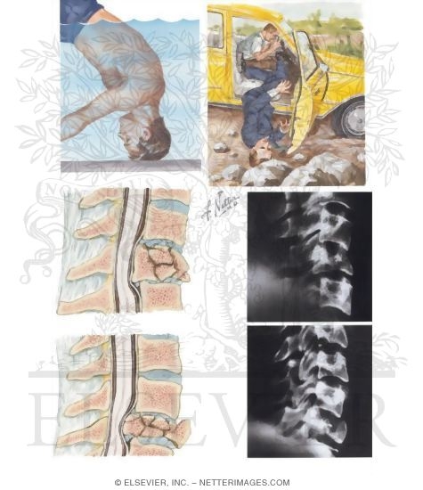 Cervical Spine Injury: Compression