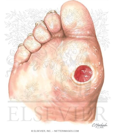 Skin Ulcer In the Diabetic Foot