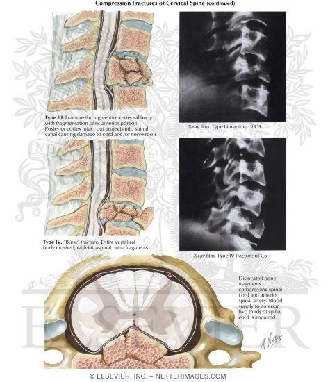 Compression Fractures of Cervical Spine