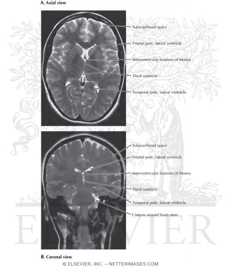 Magnetic Resonance Imaging Of The Ventricles Axial And Coronal Views