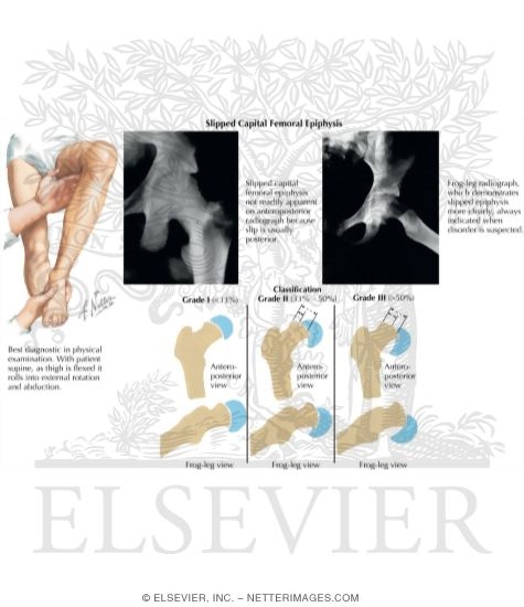 Slipped Capital Femoral