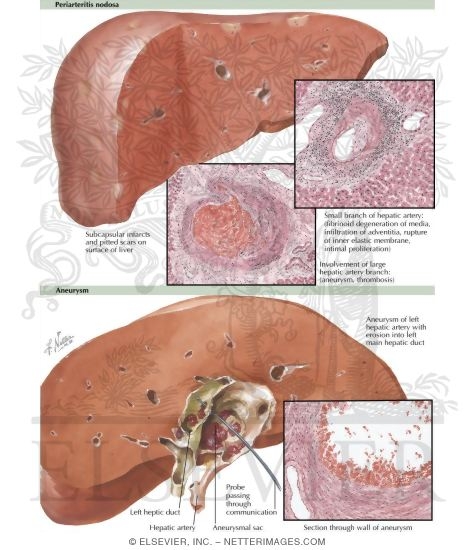 Vascular Disturbances III - Periarteritis Nodosa, Aneurysm
