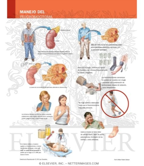 Managing Your Pheochromocytoma 9014