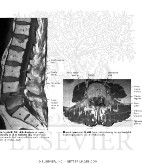 MRI of a Herniated Disc