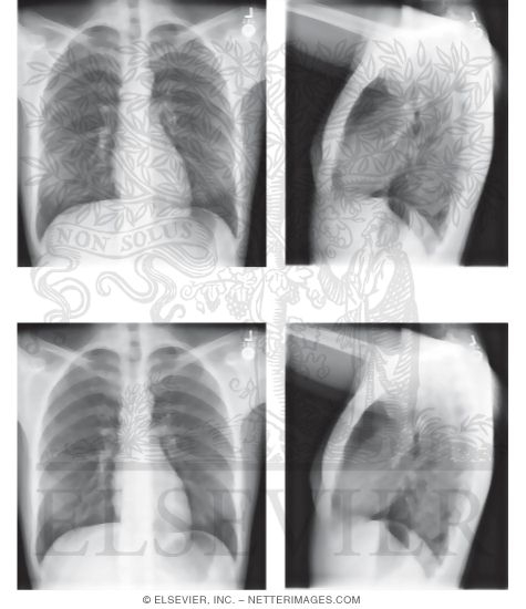PA and Lateral X-Rays: Superimposed Outlines of Lung Lobes
