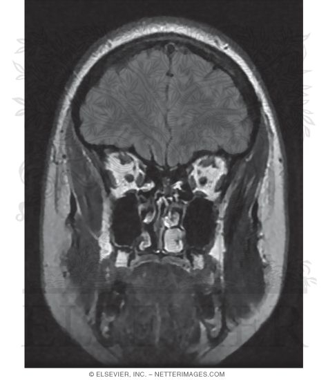 T2 FLAIR Coronal MRI Through the Frontal Lobes 
