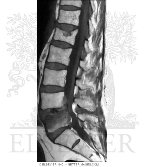 Sagittal T1 MRI of the Lumbosacral Region Showing an L4-L5 Herniated Disk