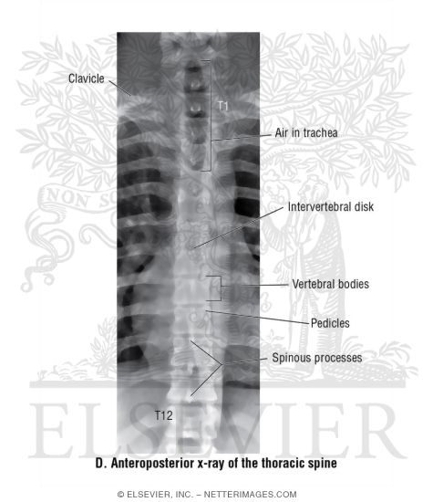 Anteroposterior X-Ray of the Thoracic Spine