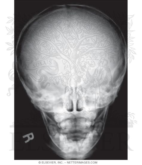 Anteroposterior (AP) X-Ray of a Child