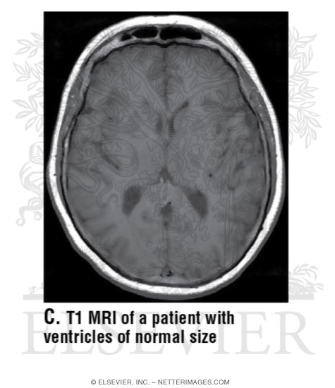 T1 MRI of a Patient With Ventricles of Normal Size