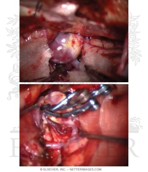 Middle Cerebral Artery Aneurysm Clipping
