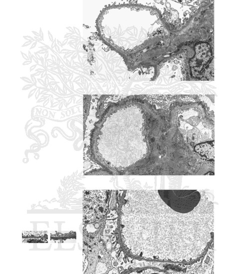 Hereditary Nephritis (Alport Syndrome)/Thin Basement Membrane Nephropathy: Electron Microscopy Findings