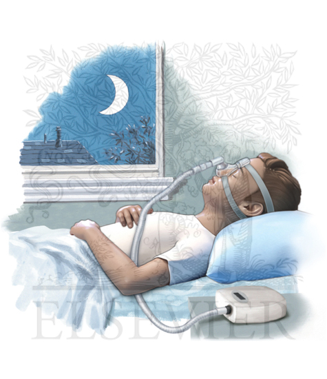 Continuous Positive Airway Pressure With Nasal Interfac (CPAP) - Pediatric nasal interface