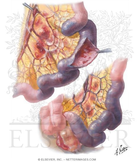 Mesenteric Vascular Occlusion