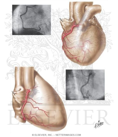 Selective Cine Coronary Arteriography
Coronary Arteries: Arteriographic Views