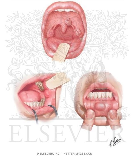 Common Oral Lesions