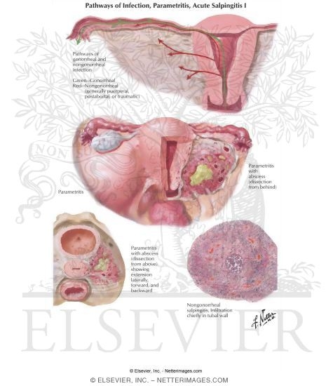 Pathways of Infection, Parametritis, Acute Salpingitis I
Endometritis