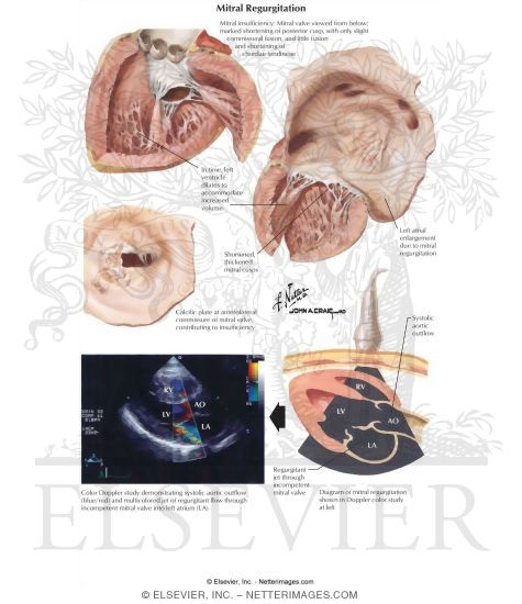 Mitral Regurgitation