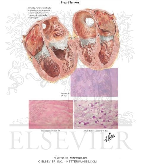 Heart Tumors