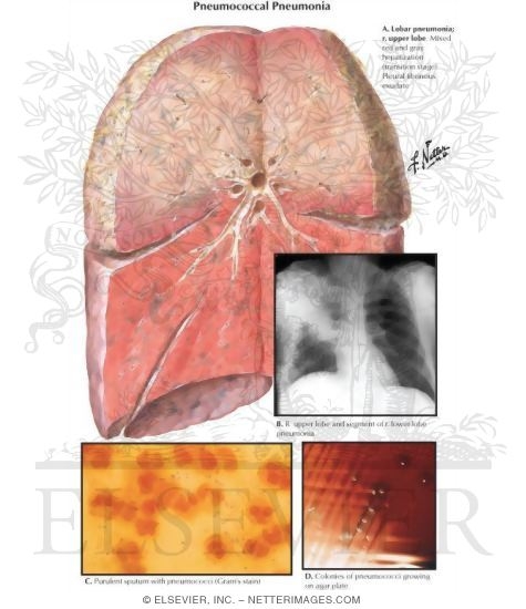 Pneumococcal Pneumonia