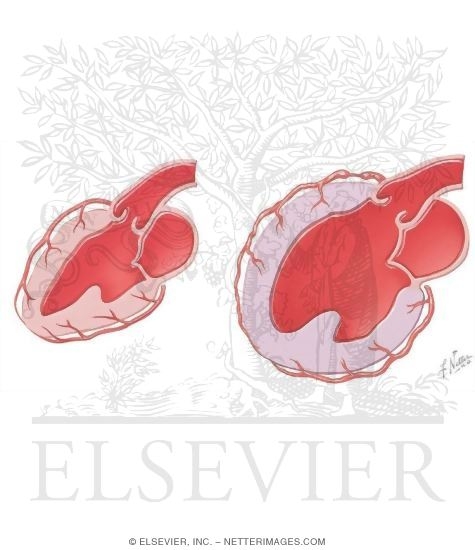 Congestive Heart Failure