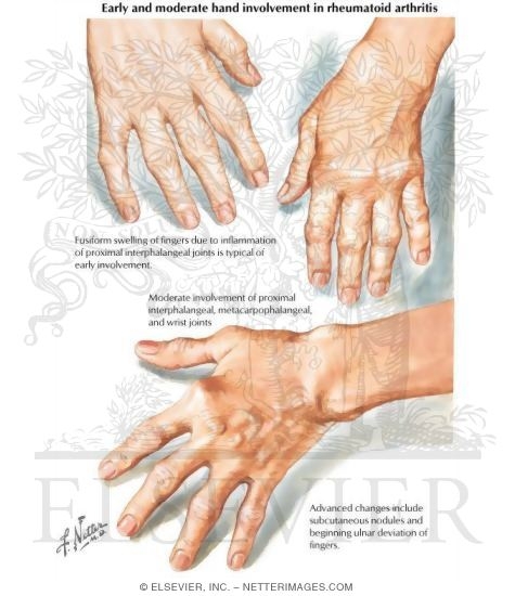 carpal arthrosis deformans ujjak ízületeinek gyulladása rheumatoid arthritis kezelése