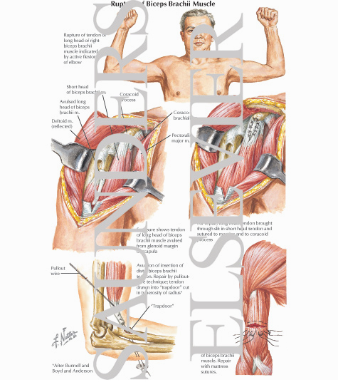 Rupture of Biceps Brachii Muscle