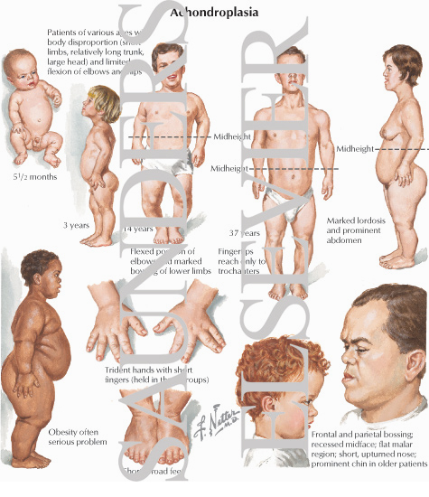 achondroplastic dwarfism