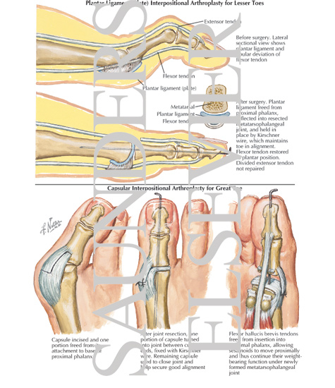 Plantar Ligament (Plate) Interpositional Arthroplasty for Lesser Toes ...