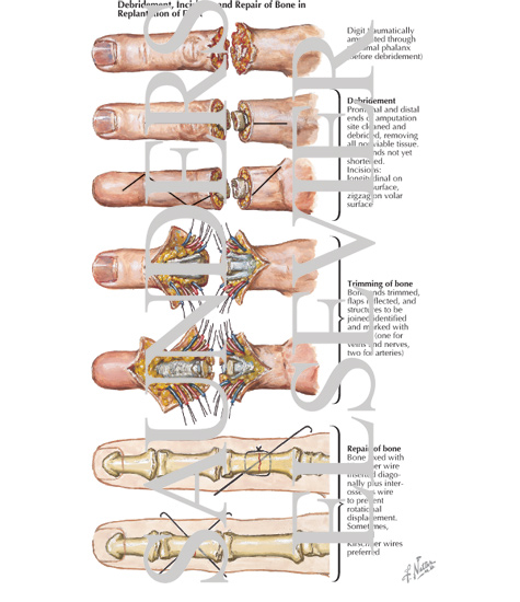 Debridement, Incisions, and Repair of Bone in Replantation of Digit