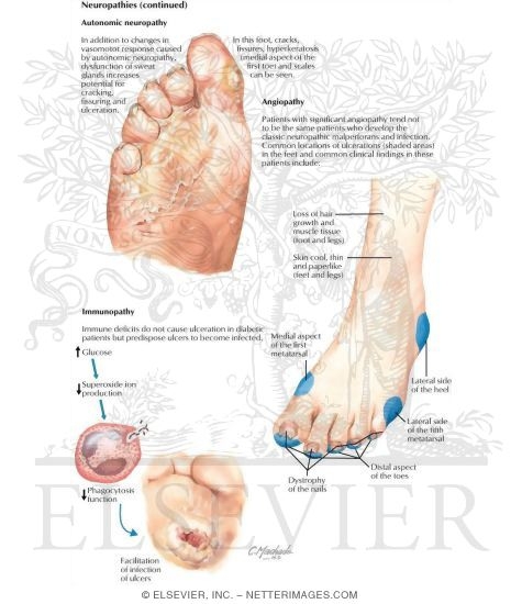 Factors Predisposing to Foot Ulcers (Autonomic)