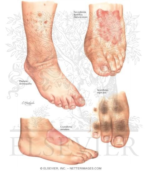 Noninfectious Cutaneous Manifestations of the Lower Extremity