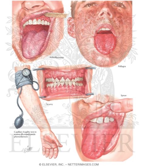 niacin deficiency tongue