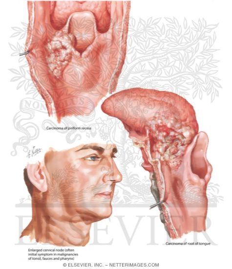 Malignant Tumors of Hypopharynx