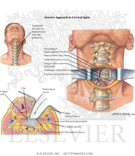 Anterior Cervical Spine Surgery