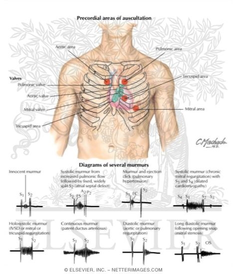Cardiac Auscultation: Precordial Areas of Auscultation