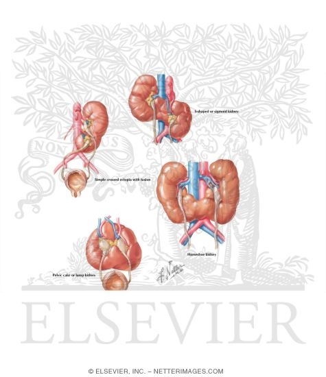 Renal Fusion