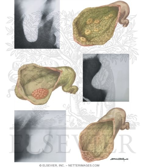 Gallstones Benign Lesions of Gallbladder