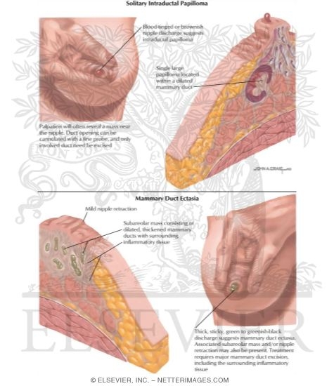 A patológiai jelentés megértése: Mellrák Atipikus ductalis hyperplasia és papilloma