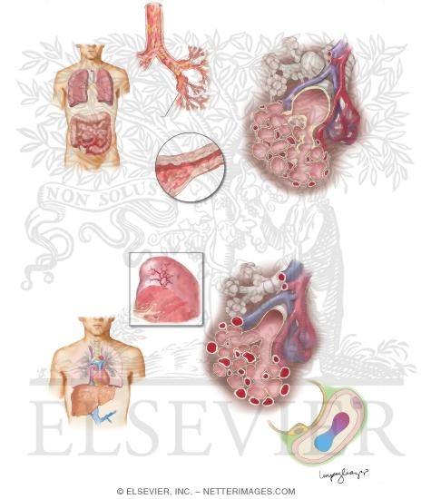 Pulmonary Manifestations of Inflammatory Bowel Disease (IBD) and Liver Disease