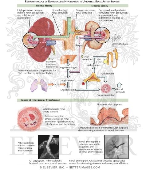 Renal Artery Stenosis Hypertension