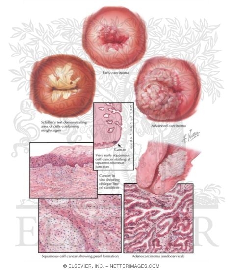 Cancer of Cervix II - Various Stages and Types