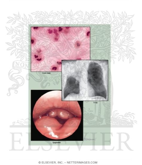 Hemophilus Influenza Pneumonia