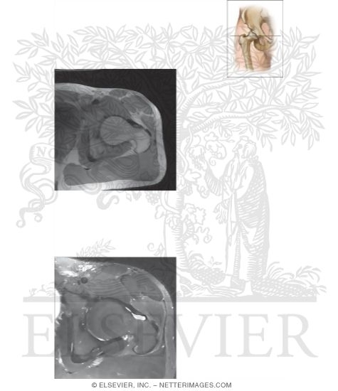 Cross Section of the Hip: Axial View