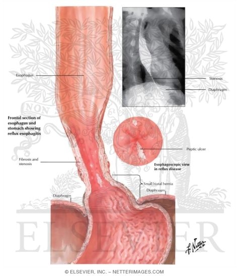 esophageal ulcer