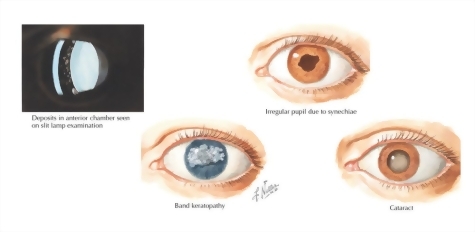 Ocular Manifestations In Juvenile Rheumatoid Arthritis