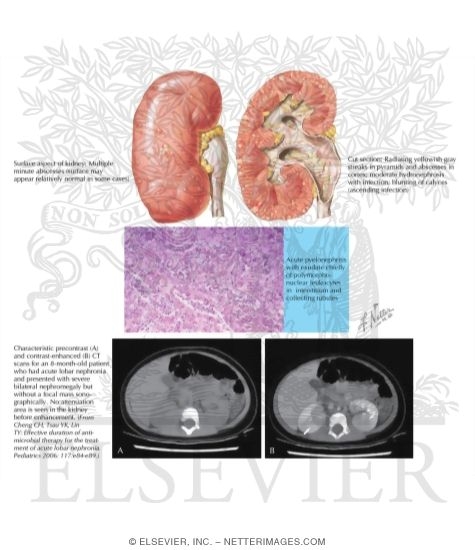 Acute Pyelonephritis: Pathology