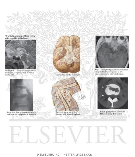 Tuberculosis of Brain and Spine